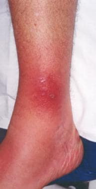 Selulitis